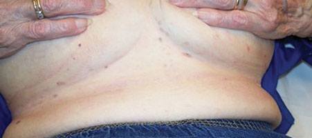 Intertrigo - dermatitis on the lower breast - Stock Image - M180