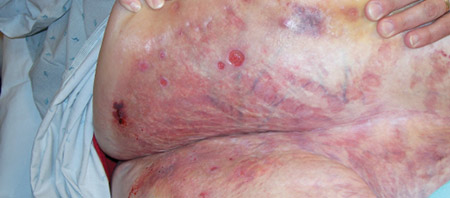 INTERTRIGO, Rash in Skin Folds, Causes, Symptoms, and Treatment -  Dr.Nischal K C